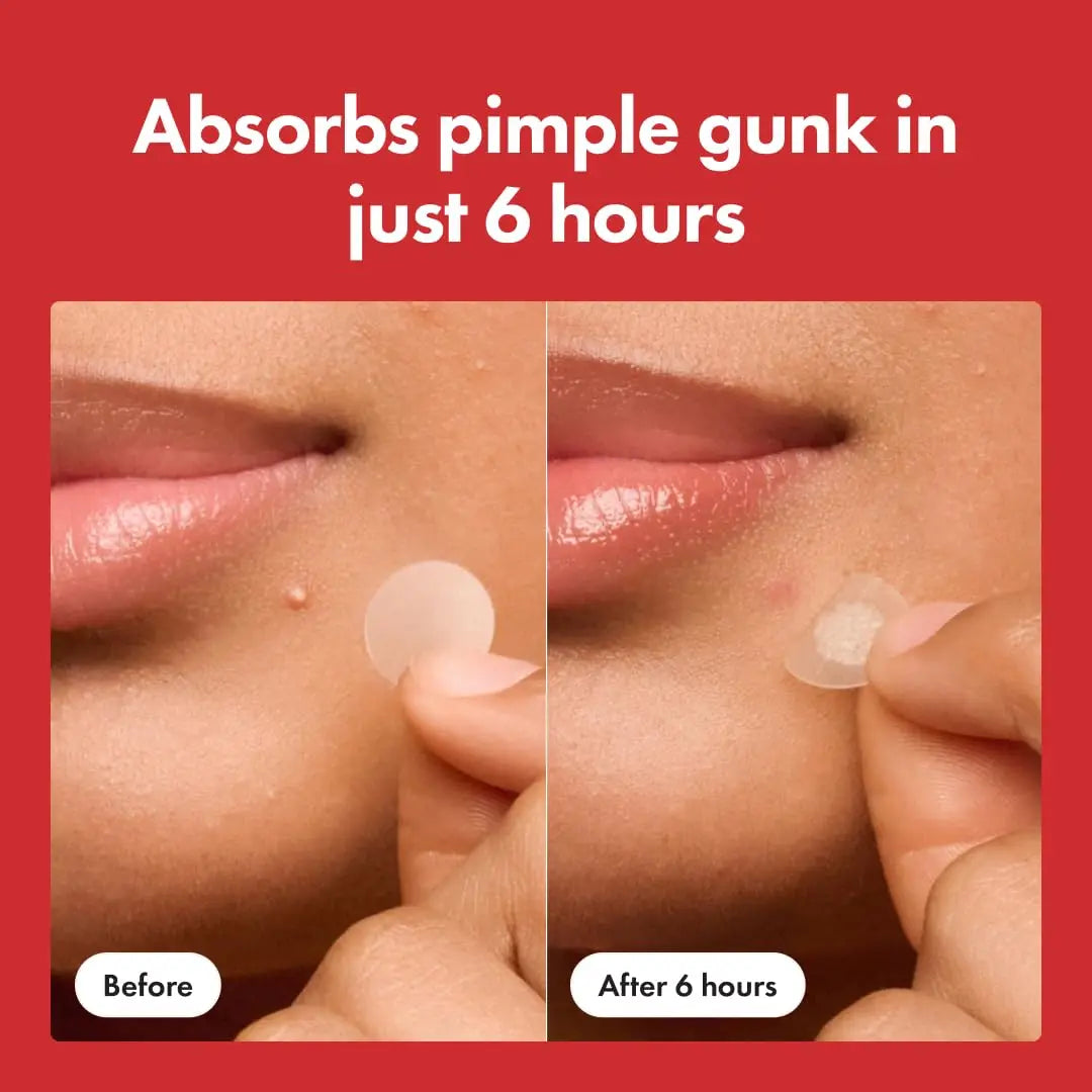 Hydrocolloid Acne Patches - Fast-Acting Pimple & Whitehead Treatment, 36 Count